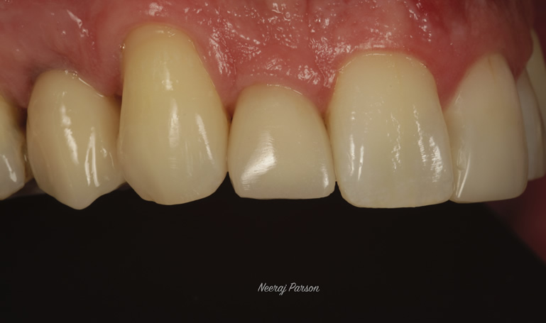 dental implants in salisbury