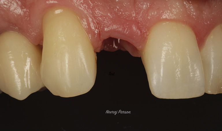 dental implants salisbury
