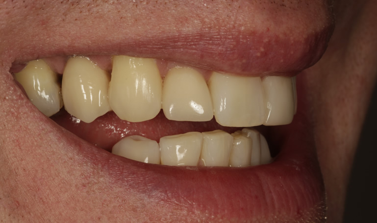 dental implants salisbury