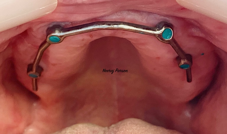 dental implants treatment salisbury