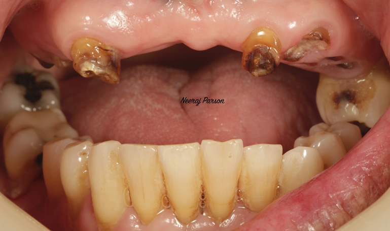 dental implants treatment in salisbury